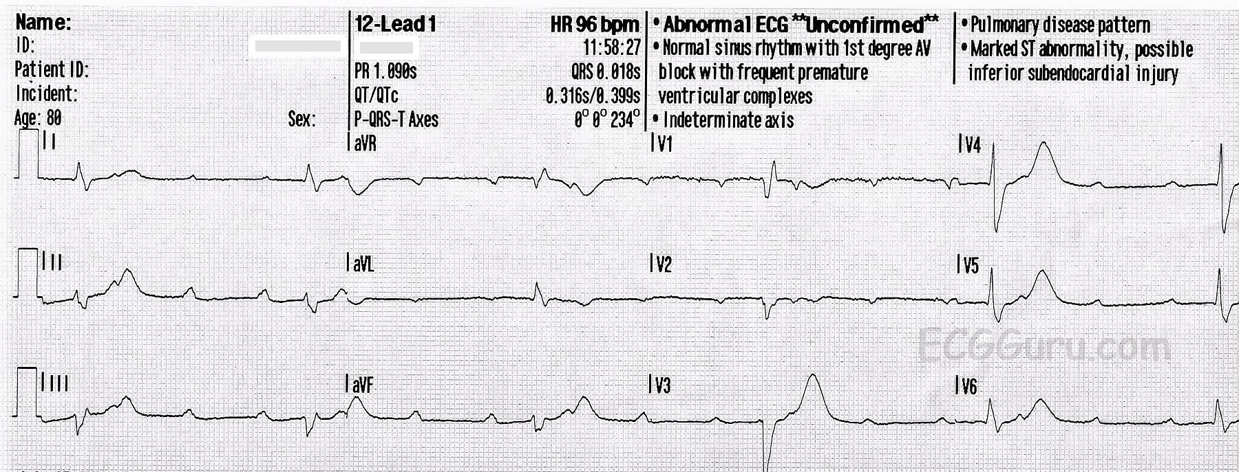 High-Grade AV Block, Second-degree AVB Type II | ECG Guru - Instructor ...